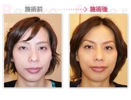 after_a